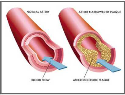 Artéria saudável x artéria com colesterol